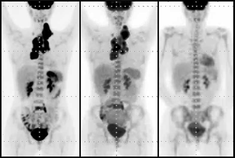 oncology-pet-scan