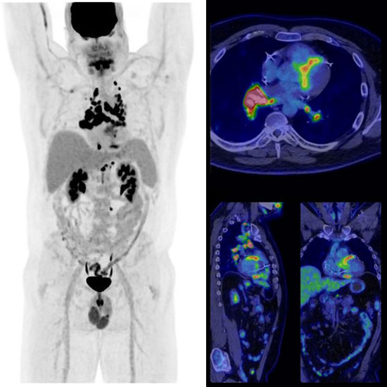 PET-CT-Scan-Cardiac-sarcoidosis