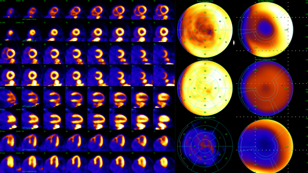 Cardiac-MPI-PET-CT