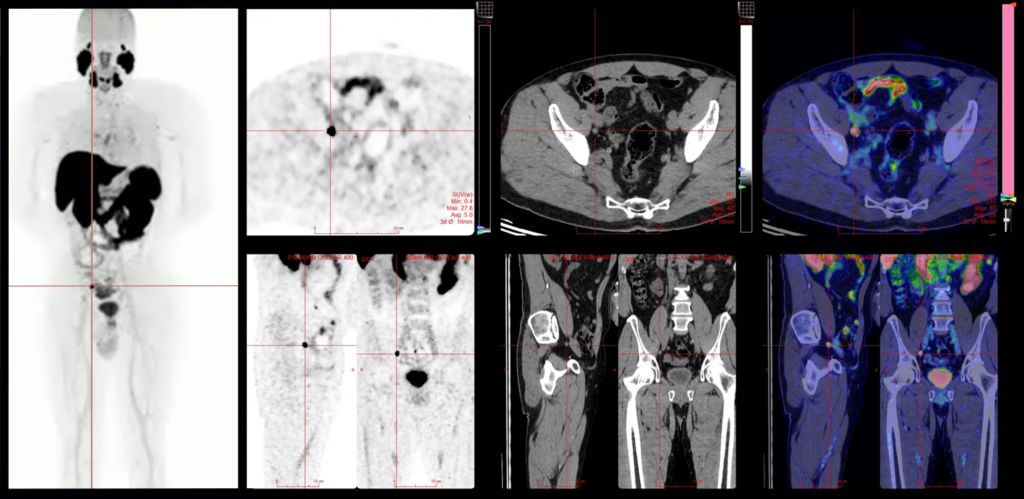 PSMA-PET-CT-Prostate-Cancer